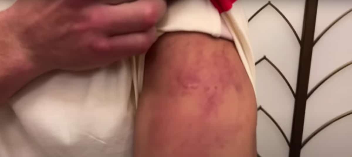 Dmitry Bivol shows off his bruised arm from Canelo Alvarez fight